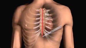 How Heart Bypass Surgery Improves Heart Function