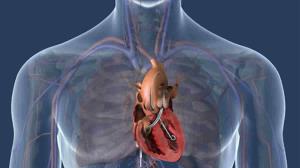 Left Ventricular Assist Device Surgery for Patients with Congenital Heart Defects