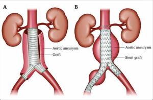 Innovations in Abdominal Aortic Aneurysm Treatment