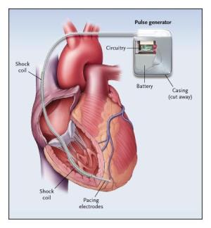 Advances in Minimally Invasive Techniques for AICD Implantation