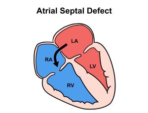 The Benefits of Early Screening for Atrial Septal Defects