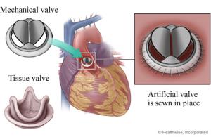 How to Prepare for Mitral Valve Replacement Surgery