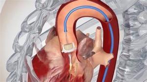 Life After TAVR: Adapting to Your New Heart Valve