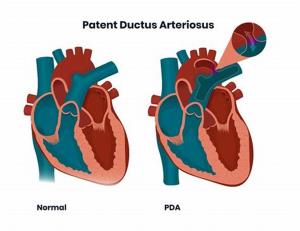 Symptoms of Patent Ductus Arteriosus Recognizing the Signs in Children and Adults