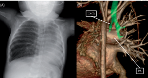 How Early Detection Impacts Tetralogy of Fallot Treatment Success