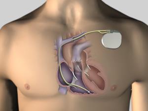 The Role of Medications in Managing Pacemaker Patients