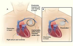 The Differences Between External and Implantable Pacemakers