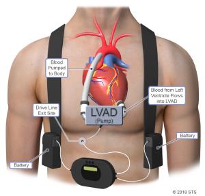 Life Expectancy with an Left Ventricular Assist Device and How Long You Can Live