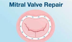 Factors That Influence the Success Rate of Mitral Valve Replacement Surgery