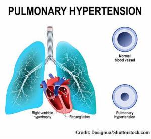 VSD and Pulmonary Hypertension: What You Need to Know