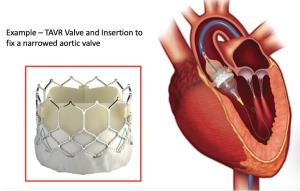 Innovations in TAVR Technology: The Future of Aortic Valve Replacement