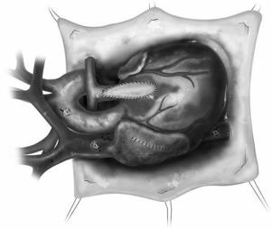 Minimally Invasive Surgical Options for Tetralogy of Fallot