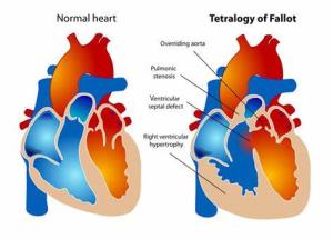 Post-Surgery Care for Tetralogy of Fallot Patients