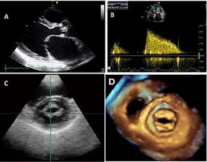 The Role of Echocardiography in Diagnosing Mitral Valve Disease