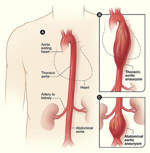 The Role of Radiology in Abdominal Aortic Aneurysm Diagnosis and Treatment