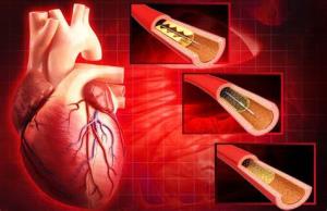 Best Coronary Angioplasty Hospitals in India