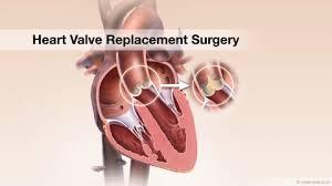 Best Heart Valve Replacement Surgery Hospitals in India