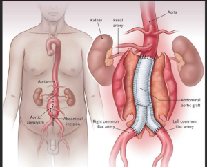 Best Abdominal Aortic Aneurysm (AAA) Hospitals in India