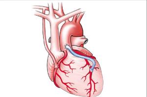 Best Heart Bypass Surgery Hospitals in India