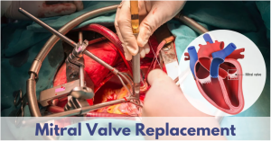 Best Mitral Valve Replacement Surgery Hospitals in India