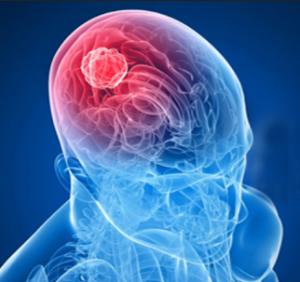 Impact of Brain Tumor Surgery on Pre-existing Conditions: Managing Diabetes, Cardiovascular Disease, and Other Health Risks