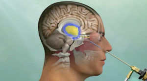 Innovative Techniques for Pituitary Tumor Surgery in India