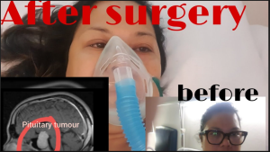 Life After Pituitary Tumor Surgery: Post-Surgery Care and Recovery in India