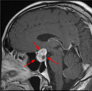 Non-Surgical Treatment Options for Pituitary Tumors in India