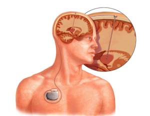 Understanding the Causes of Movement Disorders Treated by DBS