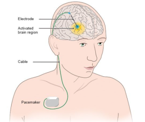 Recognizing Symptoms That May Indicate the Need for Deep Brain Stimulation