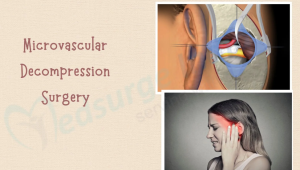 What Causes the Need for Microvascular Decompression (MVD) Surgery in India?