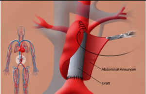 Evaluating the Success Rates of Aneurysm Repair Surgery in India