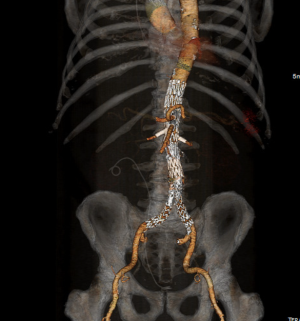 Exploring Advances in Minimally Invasive Aneurysm Repair Techniques