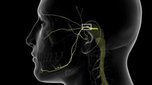 Trigeminal Neuralgia Surgery in India