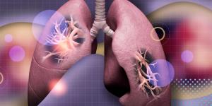 Lung Cancer Recurrence: Signs, Prevention, and Management