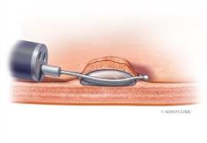 Endoscopic Mucosal Resection for Cancer Treatment