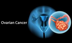 Best Ovarian Cancer Treatment in India