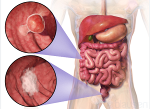 Best Colon Cancer Treatment in India