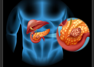 Best Pancreatic cancer treatment in India: Leading Hospitals and Doctors