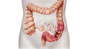 Best Colorectal Cancer Treatment in India