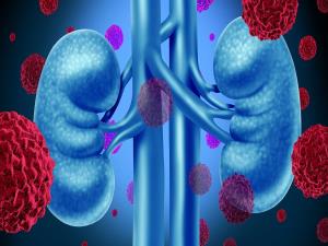 Best kidney Cancer treatment in India