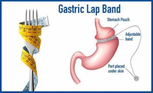 Why Exercise Matters After Laparoscopic Adjustable Gastric Banding Surgery