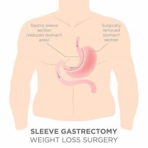 Advances in Minimally Invasive Techniques for Sleeve Gastrectomy