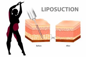 How to Prepare Your Body for Liposuction