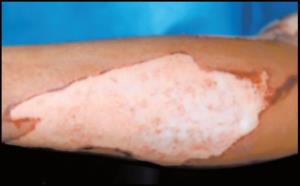 Pediatric Considerations in Skin Grafting for Burn Treatment