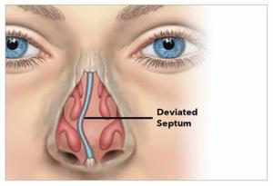 The Impact of Rhinoplasty on Breathing Function