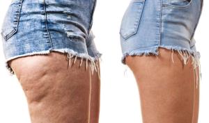 The Effect of Liposuction on Cellulite