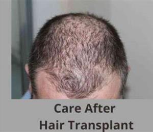 How to Maintain Your Hair After a Transplant