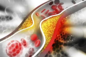 Impact of Endoscopic Sleeve Gastroplasty on Comorbid Conditions