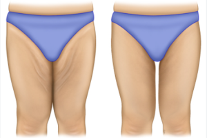 Thigh Lift Surgery in India